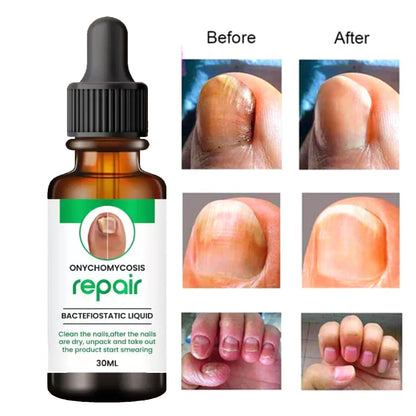 Nail Serum For Complete Nail Protection, Long healthy & fungus free nails ( pack of 2 )